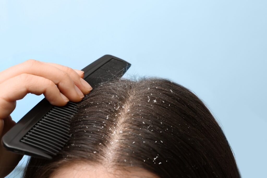 Dandruff in Winter 1